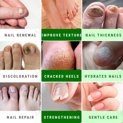Urea Nail Gel treating thick toenails for easier maintenance by Scientific Solutions Global.