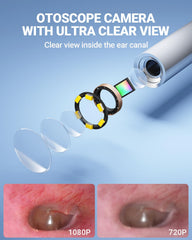 ScopeAround otoscope with HD camera and six LEDs for detailed ear viewing.