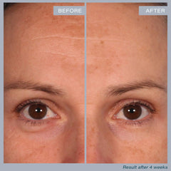 SKINN Multi-Acid Resurfacing Pads stacked for regular at-home use.