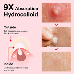 Sosky Pimple Patches stay securely in place during activity and sleep