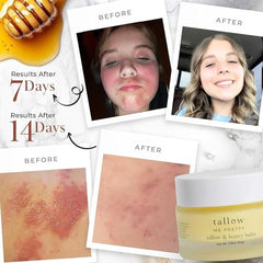 Tallow Me Pretty honey balm being applied to hands for dry skin relief.