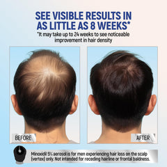 Application of TARO Minoxidil foam demonstrates easy scalp delivery