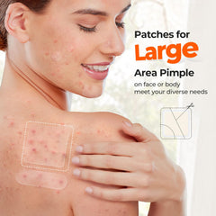 TKTK 8mm spot patch for precise coverage of small pimples.