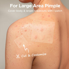 TKTK pimple patch 12mm seals bigger spots with breathable hydrocolloid.