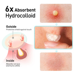 TKTK Pimple Patch with ultra-thin edge blends into the skin.