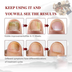 Before-and-after look at nails after using Toenail Treatment for Discoloration.