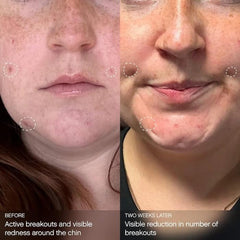 Topicals Clearly Breakout Mask close-up shows smooth texture after application.