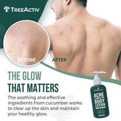 TreeActiv back acne solution bottle closeup showing fast-absorbing formula for acne-prone skin.