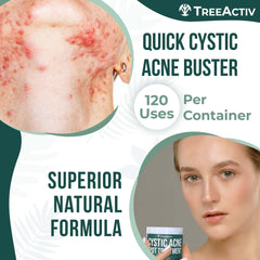 TreeActiv spot treatment applied on cheek demonstrates creamy texture