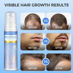 Trzsfr Minoxidil Foam on beard for potential facial hair growth.