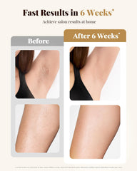 UENMOON IPL Energy Density 13J targets hair roots for effective care.