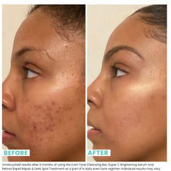 Urban Skin Rx Even Tone Cleansing Bar with exfoliating sponge promotes routine exfoliation