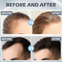 VANKEPYO derma roller for hair application to support scalp care.