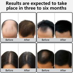 Verfubo Laser Therapy Hair Growth Comb in use on scalp for follicle-friendly treatment