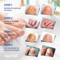 VigorWell overnight skin-toned patch for discreet nail care.
