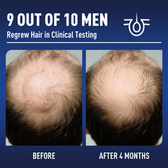 Wuwenbin biotin-infused minoxidil formula bottle close-up for everyday use