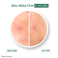 Y'OUR patches drawing out impurities to help blemishes appear calmer by morning.