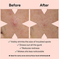 ZVYK pimple patches cute-patterns display versatile wear for daily activities
