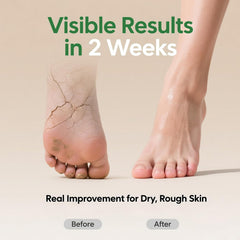 Foot application with ZyraGloz cream on cracked heels.
