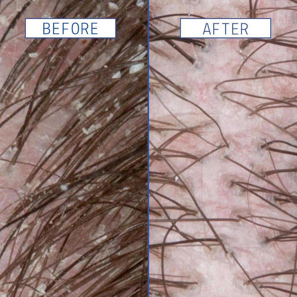 AAVRANI Scalp Rescue Serum dropper ready for targeted scalp application.