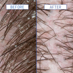 AAVRANI Scalp Rescue Serum dropper ready for targeted scalp application.