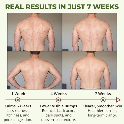 ABERA back acne care routine shot showing easy daily wash.