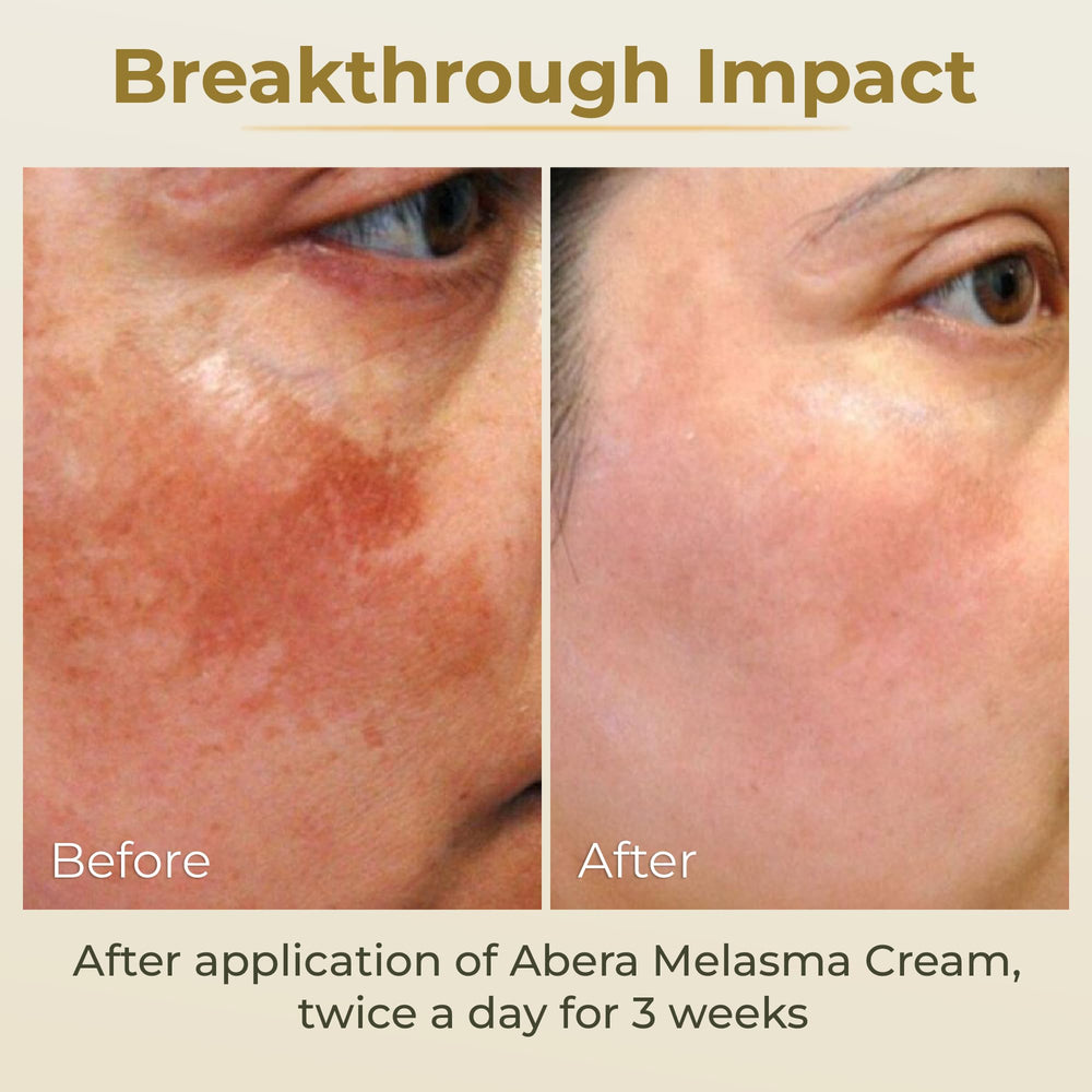 Application douce matin et soir avec ABERA Crème Mélasma sur la peau.