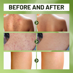 ABERA tea tree oil feature on skin purification and calm.