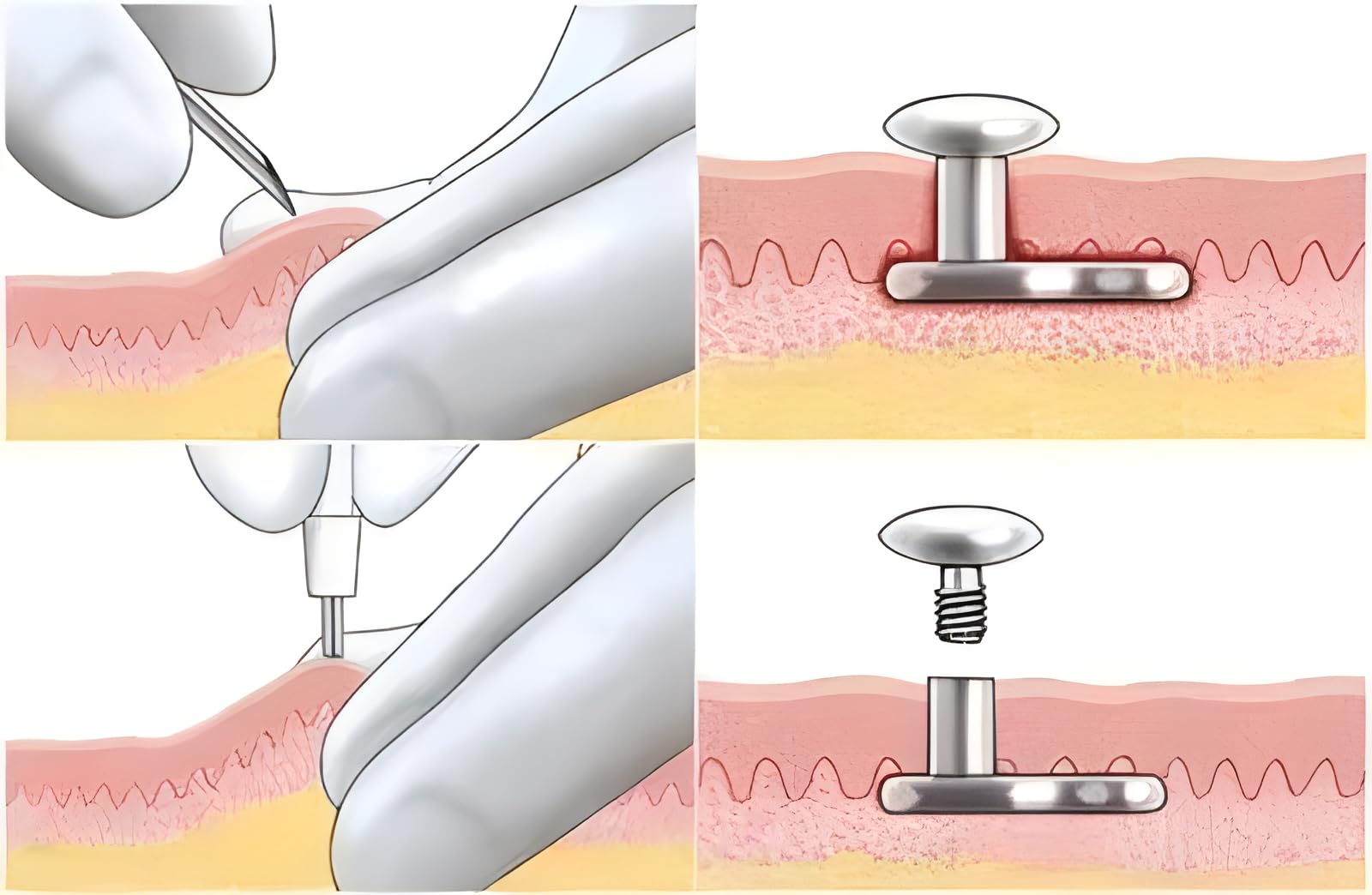 AccGin single-use design supports hygienic and convenient piercing procedures.