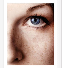 Before-after image of ACM Depiwhite demonstrates potential fade of brown spots