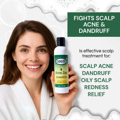Acne Zap shampoo scalp application illustrates soothing wash for itchy scalp.