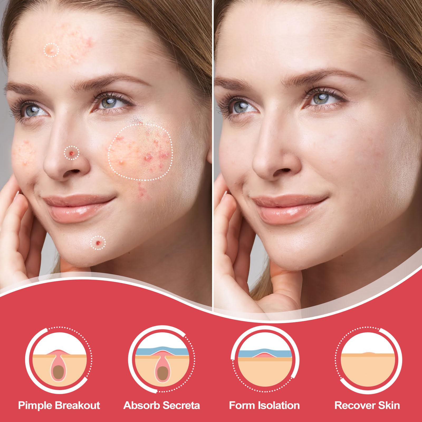 AcneGo invisible matte finish patches applied for subtle, daily coverage.