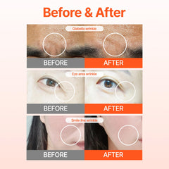 Acropass RETI-RN patch applied near the eye area for precision coverage
