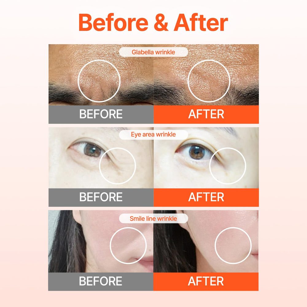 Acropass RETI-RN patch applied under-eye area for wrinkle care