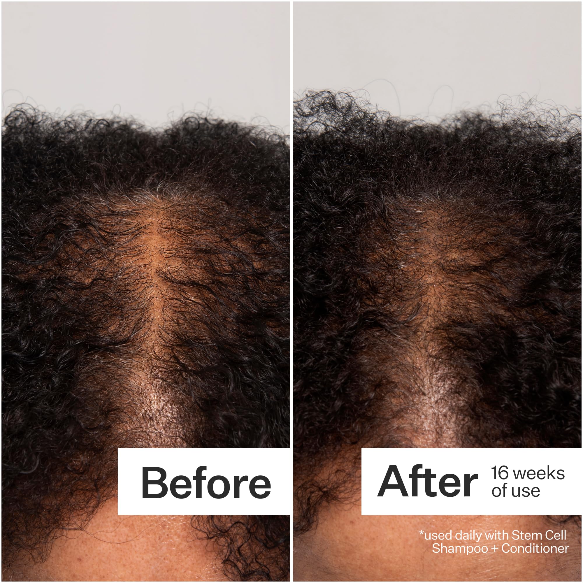 ACT+ACRE close-up spritz on scalp showing easy daily use.