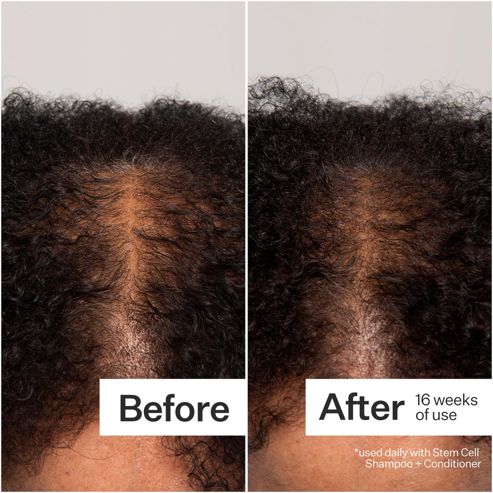 ACT+ACRE close-up spritz on scalp showing easy daily use.