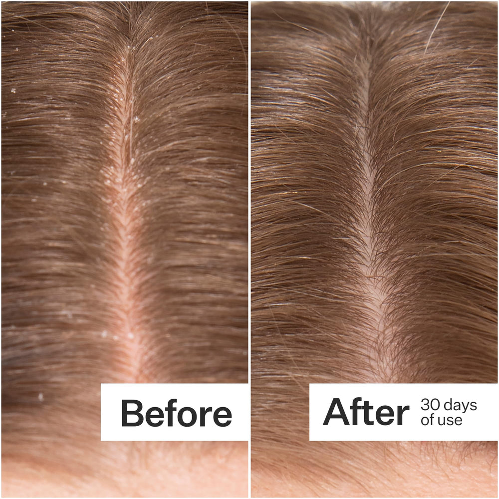 ACT+ ACRE Peppermint oil essence close-up highlighting refreshing menthol sensation for scalp