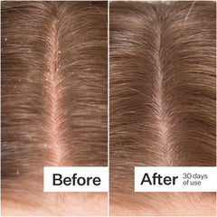 ACT+ ACRE Peppermint oil essence close-up highlighting refreshing menthol sensation for scalp