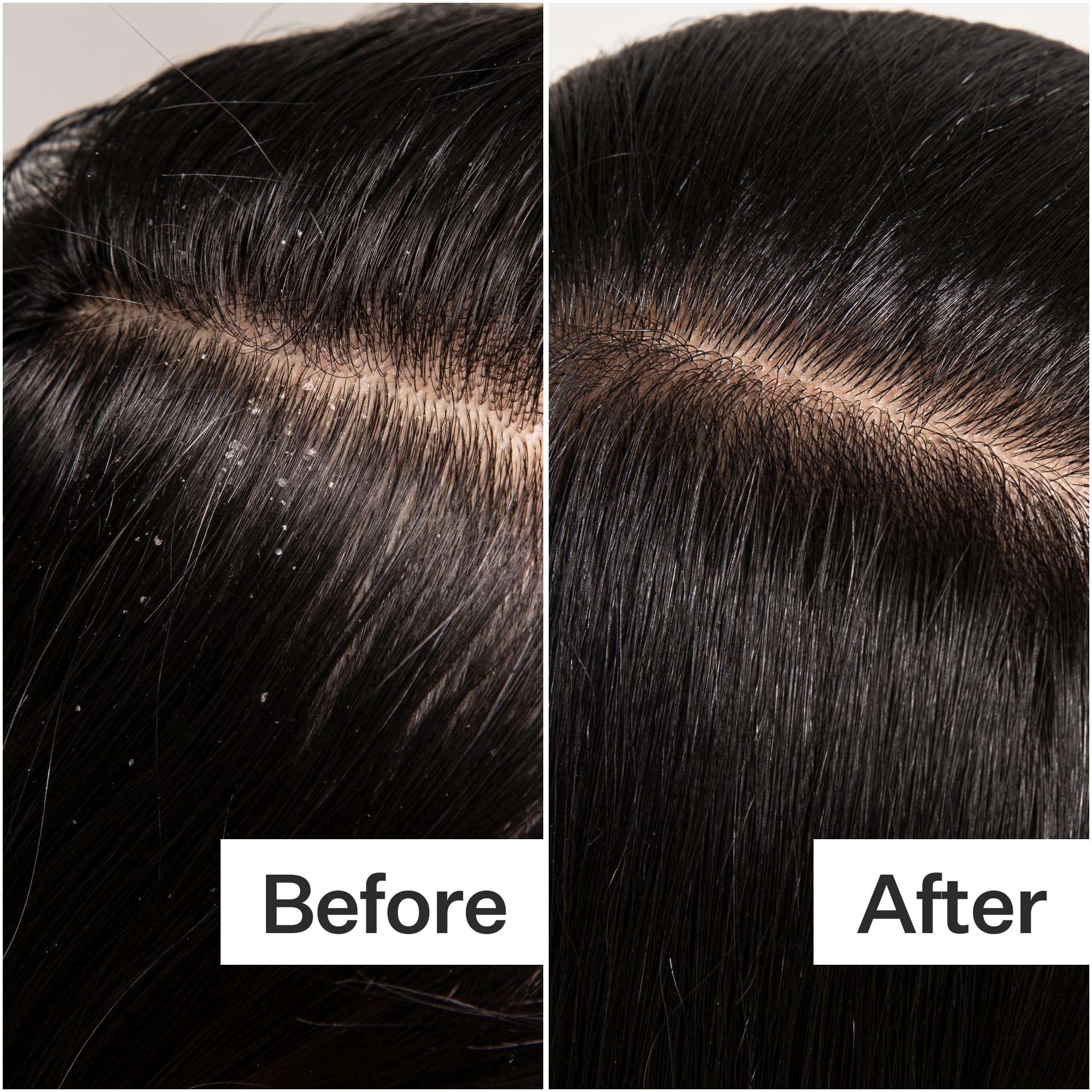 ACT+ ACRE deep cleanse removes scalp buildup, leaving a refreshed base.
