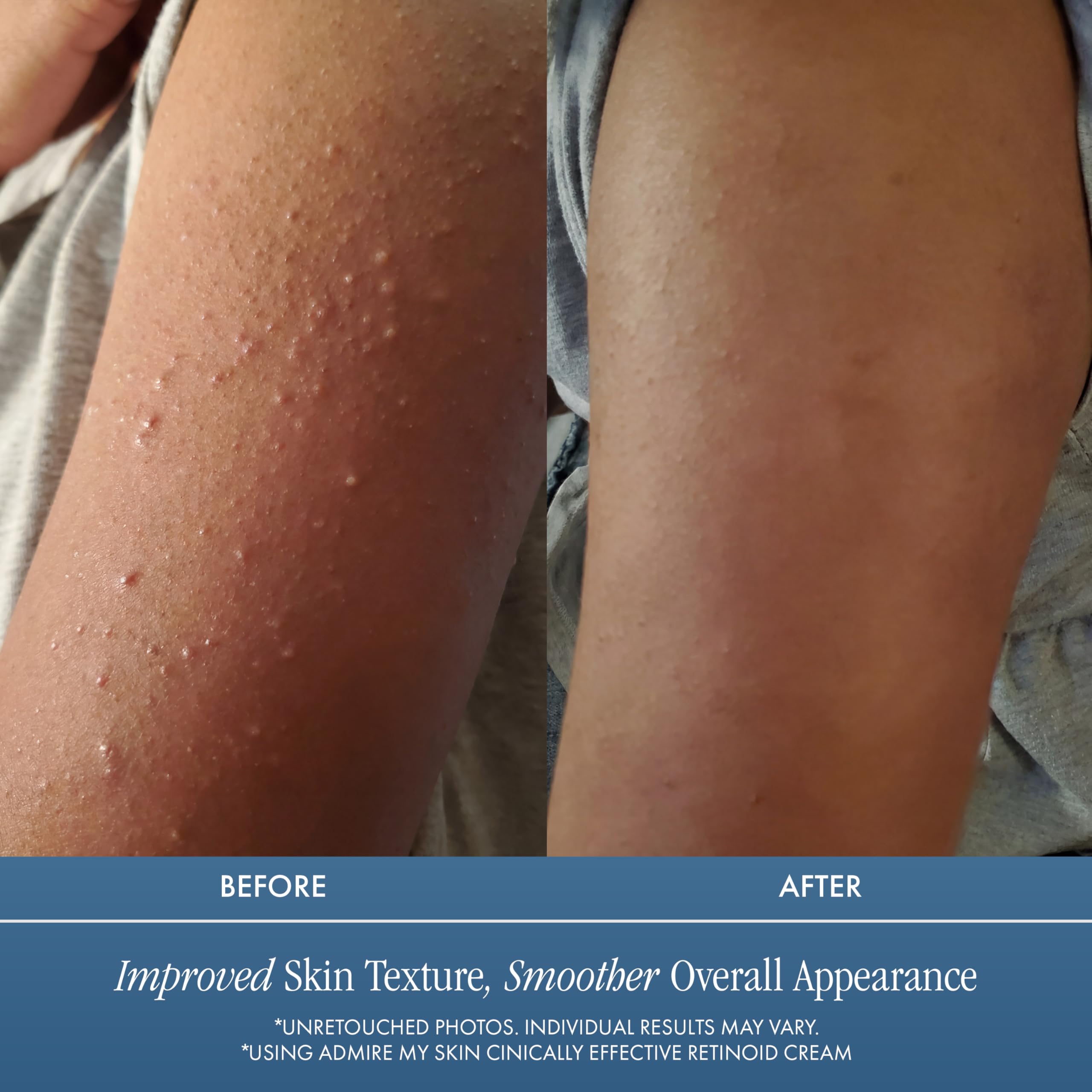 Admire My Skin Potent Retinoid Cream ready for night-time application.