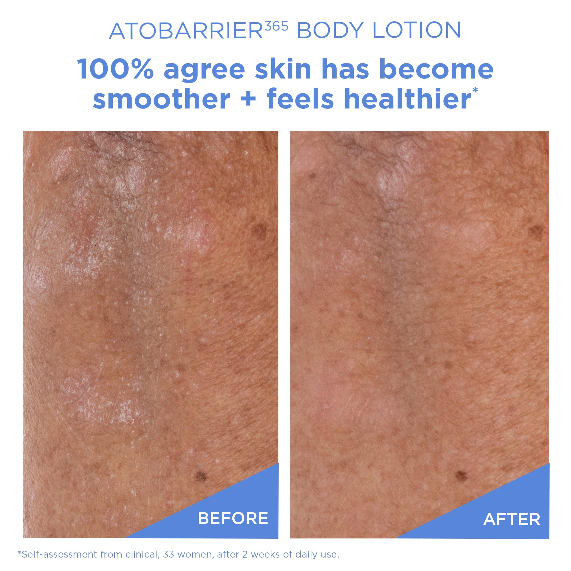 AESTURA ATOBARRIER365 long-lasting hydration on dry skin detail.