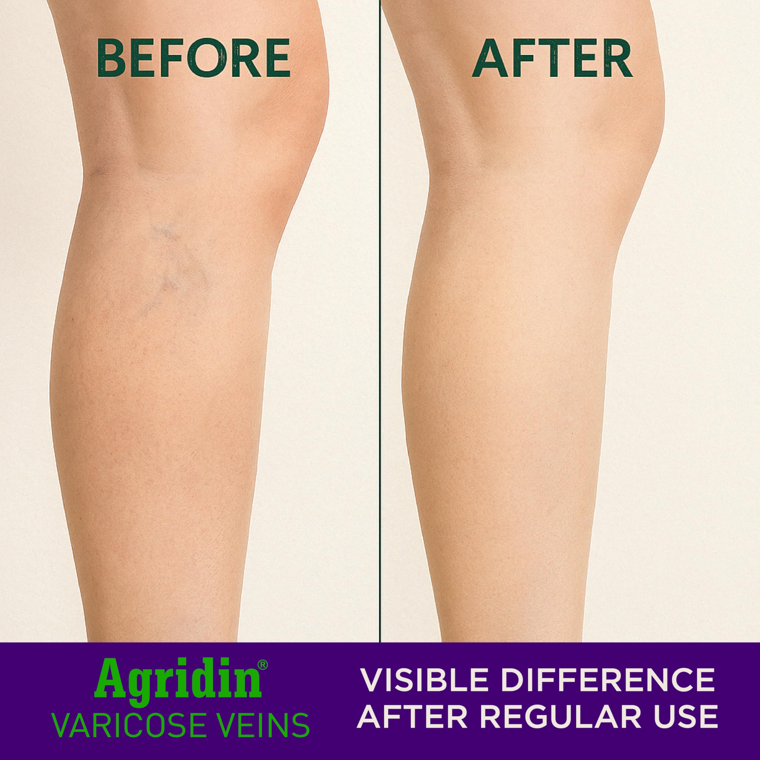 Orange oil and rosemary oil highlights in the Agridin cream.