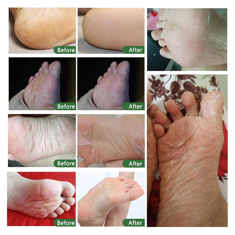 ALIVER Foot Peel Mask 3-pack exfoliates calluses by shedding dead skin