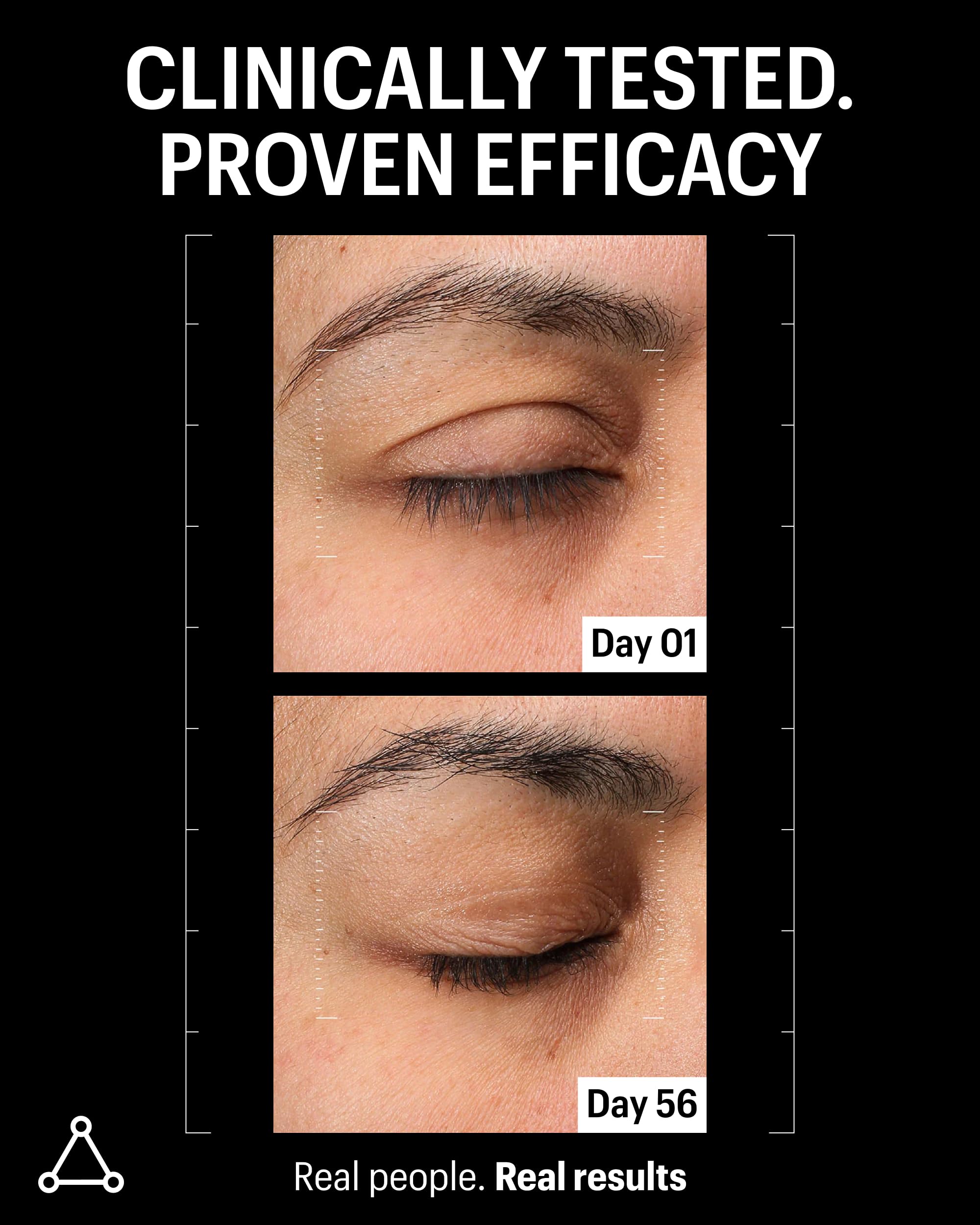 Allies of Skin eye-area-wrinkles-before-after demonstrates visible refinement around the eyes.