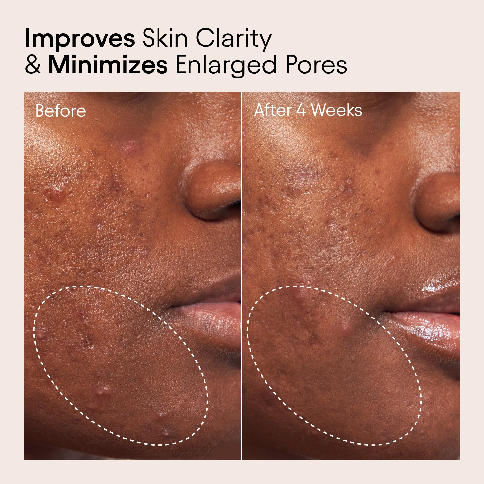 Alpyn Beauty Pore Toner applying drops on skin for gentle exfoliation.