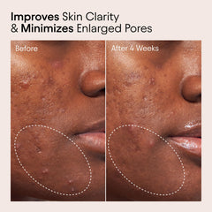 Alpyn Beauty Pore Toner applying drops on skin for gentle exfoliation.