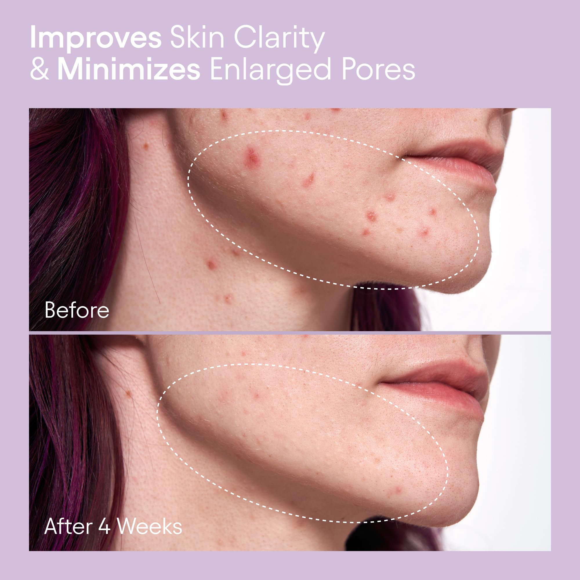 Alpyn Beauty Pore Toner glass bottle with herbal ingredients suggests natural potency.