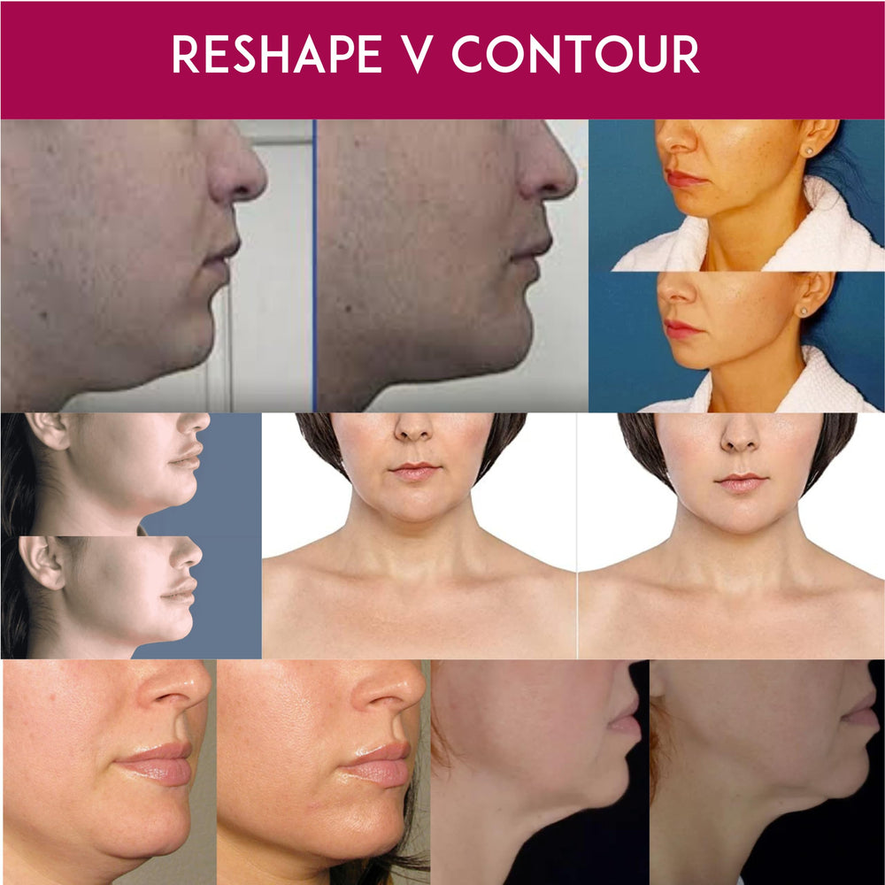 Anacis Advanced Neck Cream neck contour close-up highlighting tightening effect