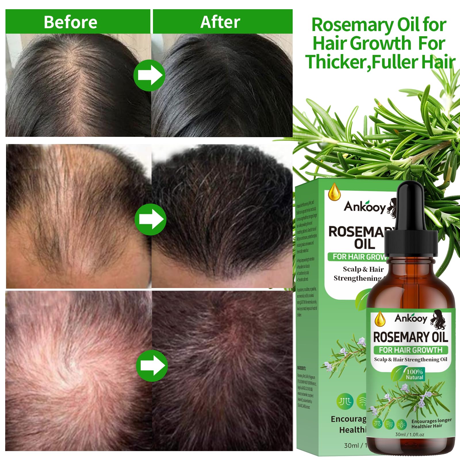 ANKOOOY rosemary oil scalp-nourishment demonstrates soothing care for itchy scalp.
