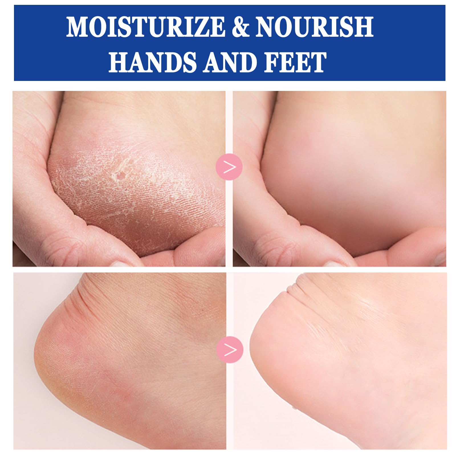 Anweina foot cream suitable for feet, hands, elbows and more.